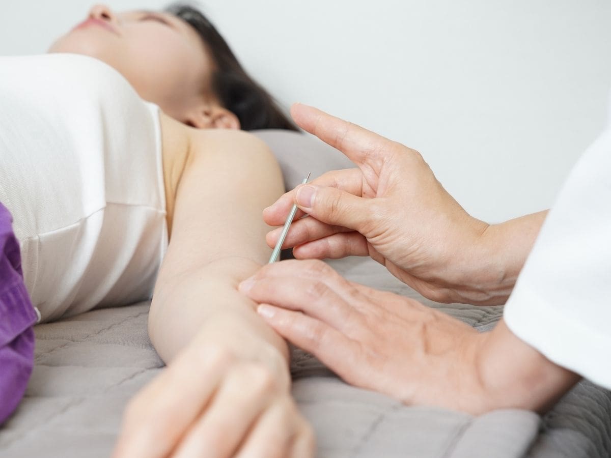 A practitioner performs acupuncture on a patient’s arm to relieve stress and support emotional balance.