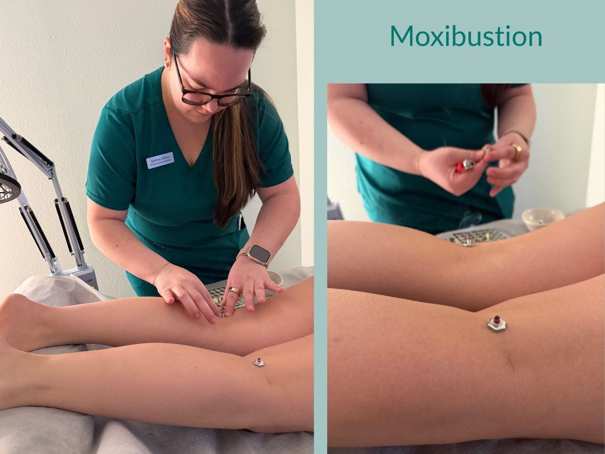 Moxibustion treatment using moxa placed on acupuncture points delivering gentle heat to support those with autoimmune diseases. 