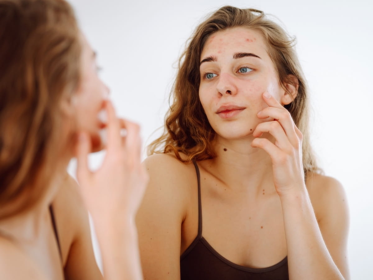A women considering microneedling treatment for her skin and acne.