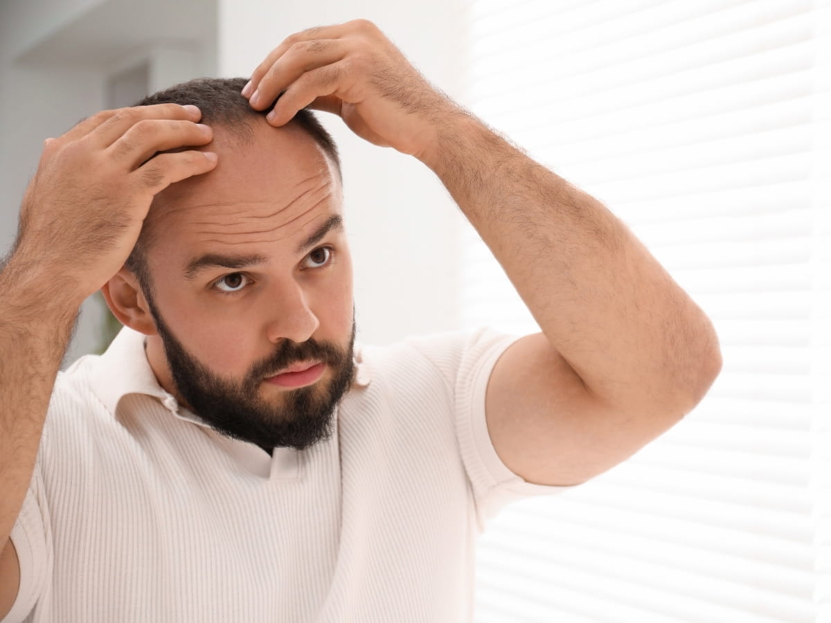 A man considering microneedling treatment to help with his hair loss and for its hair restoration benefits.