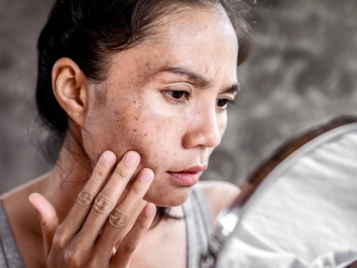 A women looking at her facial skin in the mirror wondering if microneedling treatment is right for her. 