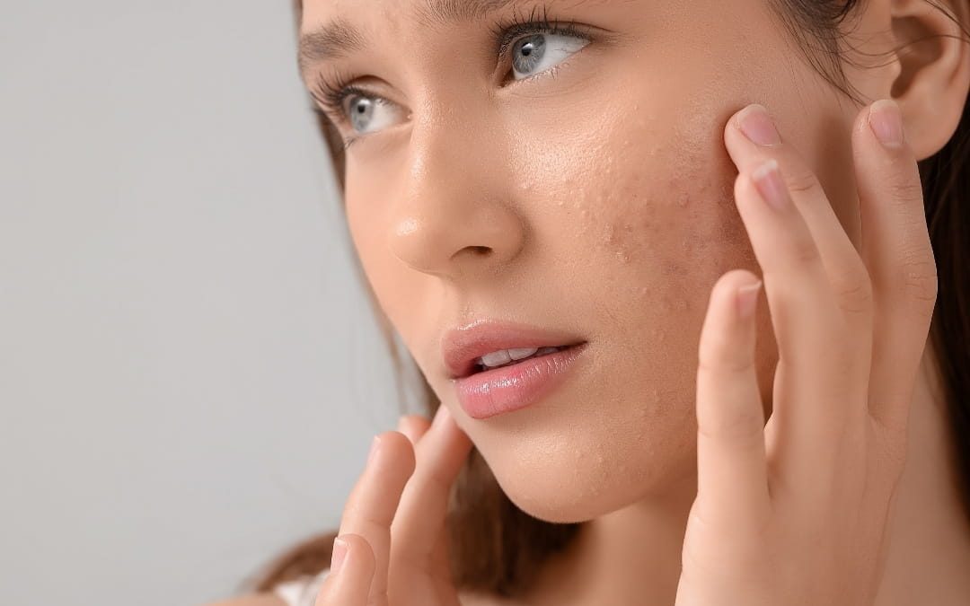 Acne Treatment Options for Clear, Healthy Skin