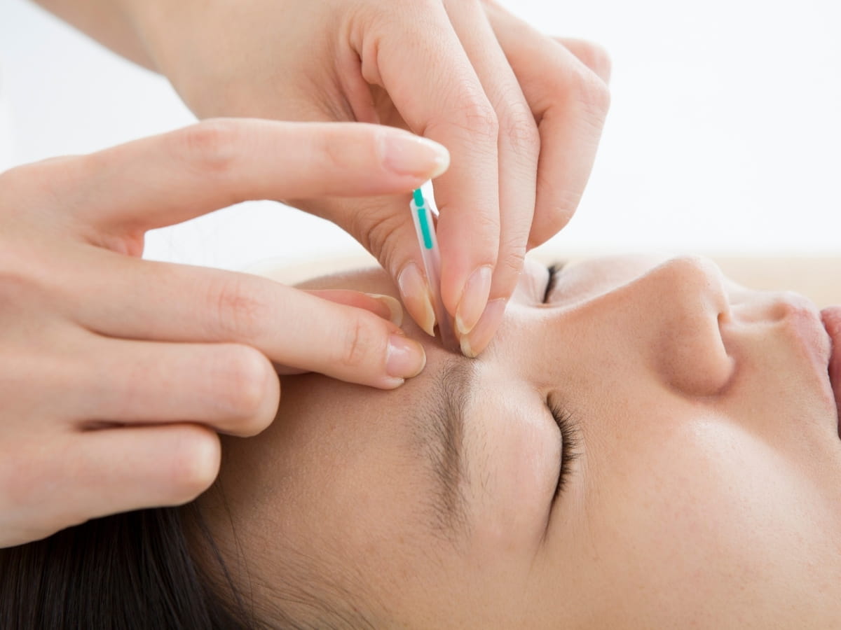 A women receiving facial acupuncture as part of a personalized acne treatment approach.