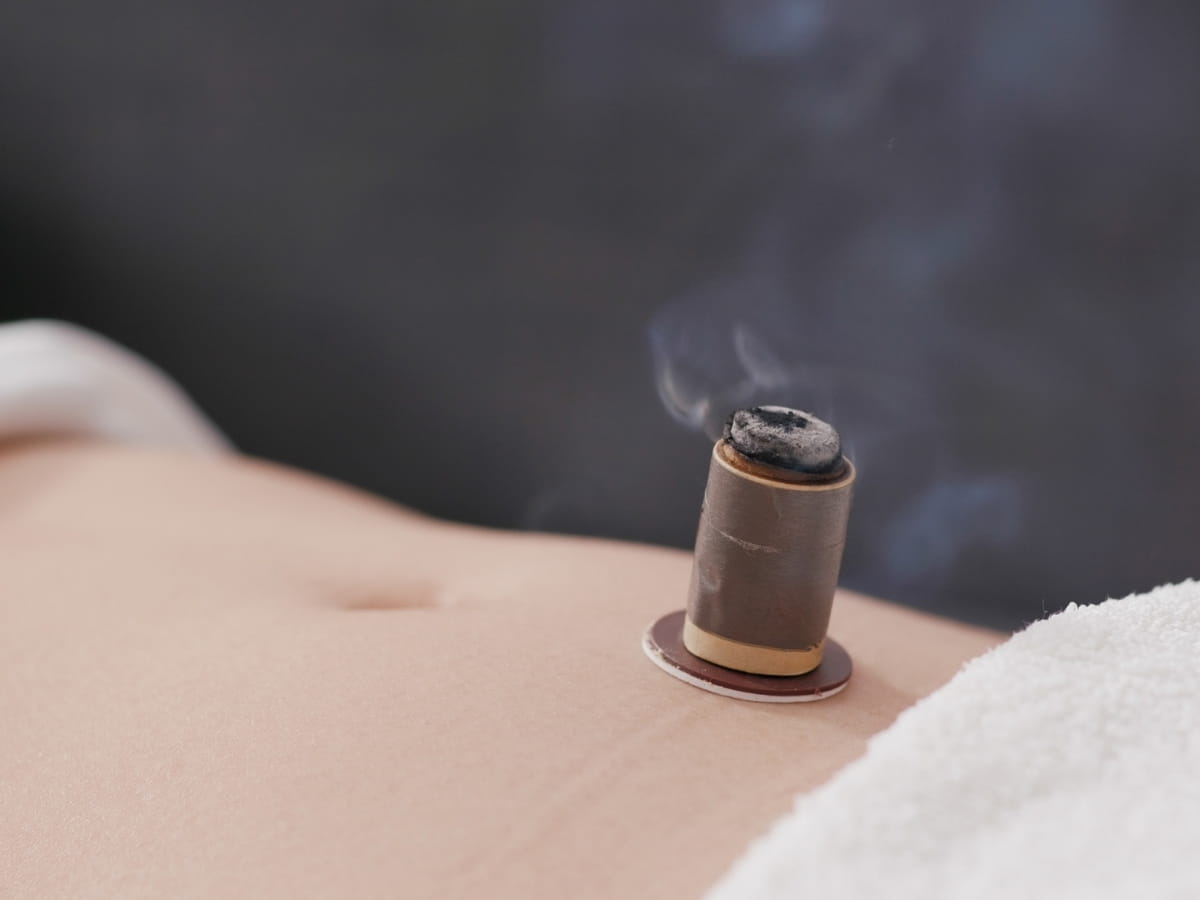 Moxibustion burning on a patients skin on a digestive acupuncture point as part of a personalized acne treatment.