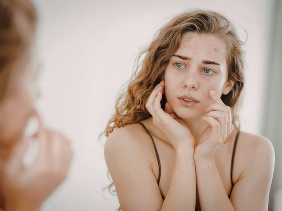 A woman examining facial acne in the mirror, highlighting the need for personalized acne treatment.